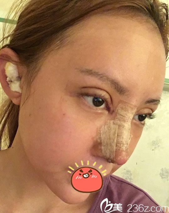 在寧波童顏做隆鼻和雙眼皮3天照片 在寧波童顏做隆鼻和雙眼皮3天照片