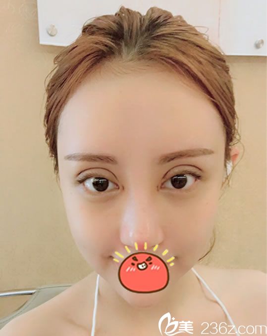 做完雙眼皮和隆鼻手術7天恢復照 做完雙眼皮和隆鼻手術7天恢復照