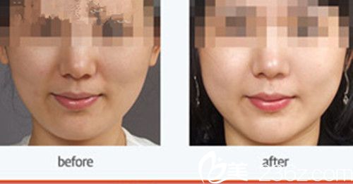 韓國朱麗葉整形醫(yī)院面頰、貴族填充針案例