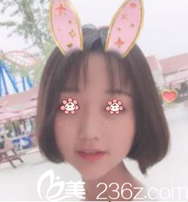 LEE CHONG RYANG自體脂肪面部填充術(shù)后半個月 LEE CHONG RYANG自體脂肪面部填充術(shù)后半個月