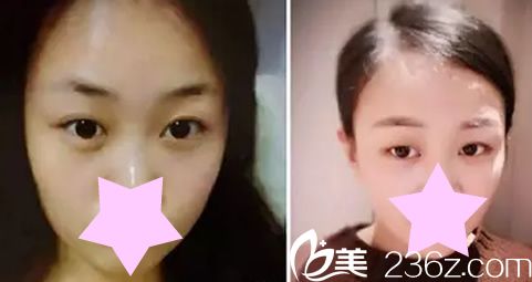 全切雙眼皮術(shù)前照片