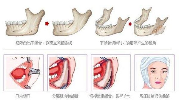 下頜角手術(shù) 下頜角手術(shù)
