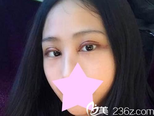 鄭醫(yī)生切開+內(nèi)開眼角綜合術(shù)7天后圖片案例 鄭醫(yī)生切開+內(nèi)開眼角綜合術(shù)7天后圖片案例