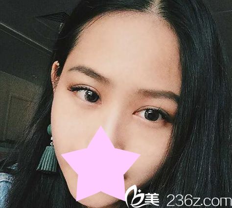 韓國紫馨整形美容眼綜合手術(shù)20天恢復(fù)效果 韓國紫馨整形美容眼綜合手術(shù)20天恢復(fù)效果