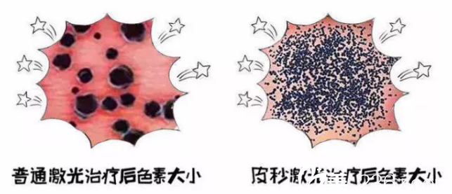 蜂巢皮秒和普通激光對比