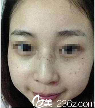 皮秒祛斑術(shù)后次效果