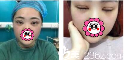 韓國江南stardom整形外科陳尚佑雙眼皮真人案例術(shù)后第三天