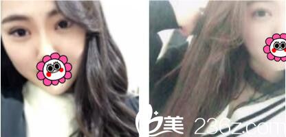 韓國江南stardom整形外科陳尚佑雙眼皮真術(shù)后第七天人案例