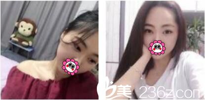 韓國江南stardom整形外科陳尚佑雙眼皮真人案例術(shù)后一個月