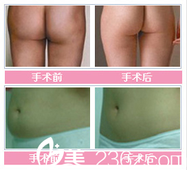 張家港康麗整形醫(yī)院吸脂整形對(duì)比案例 張家港康麗整形醫(yī)院吸脂整形對(duì)比案例