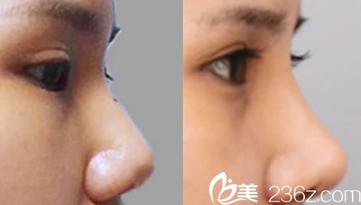 韓國(guó)然美之整形隆鼻效果圖