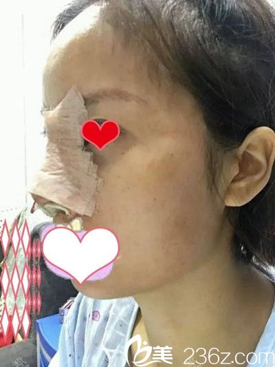 鼻綜合手術(shù)后1天