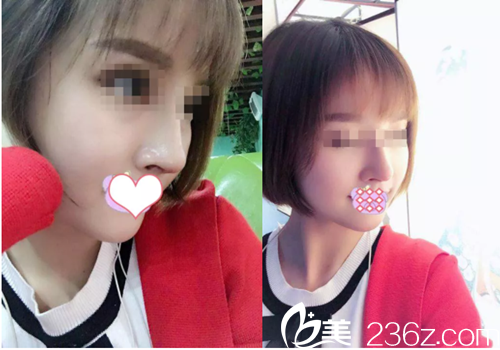 劉志強院長給我做鼻綜合手術(shù)35天了