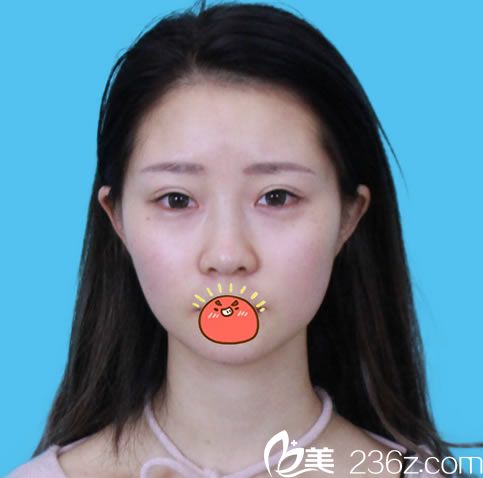 前一次在溫州瑞麗做完雙眼皮效果 前一次在溫州瑞麗做完雙眼皮效果