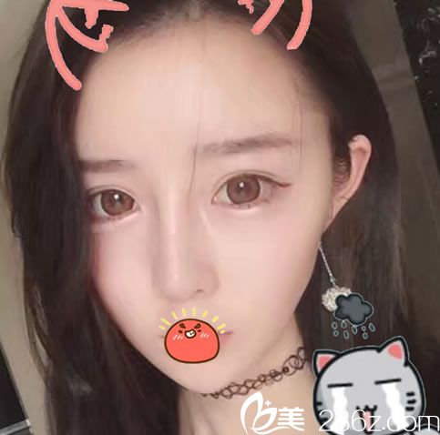 選擇溫州瑞麗做隆鼻10天效果 選擇溫州瑞麗做隆鼻10天效果