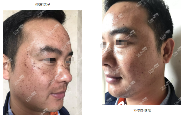 皮秒祛斑術(shù)后恢復(fù)過程中 皮秒祛斑術(shù)后恢復(fù)過程中
