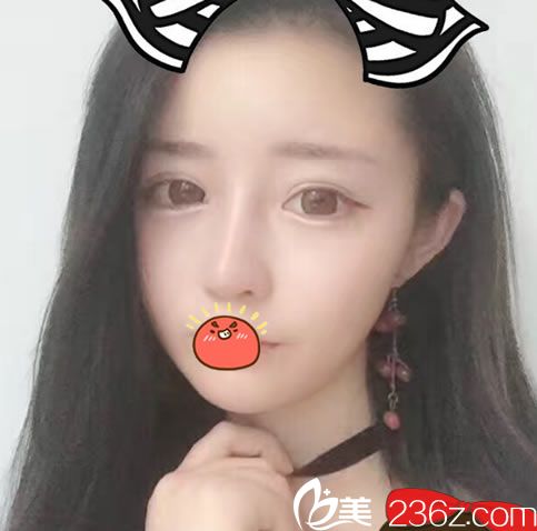 做完隆鼻和脂肪填充50天恢復(fù)照 做完隆鼻和脂肪填充50天恢復(fù)照