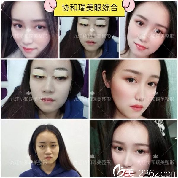 九江星瑞美雙眼皮案例