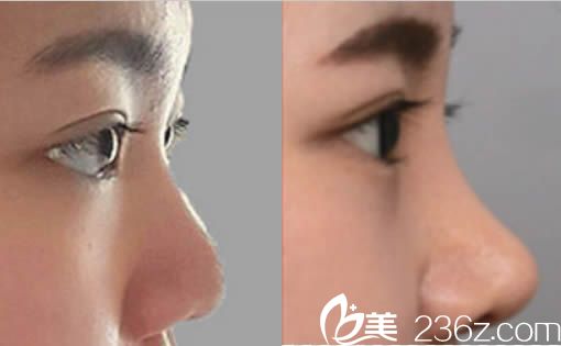 韓國然美之整形醫(yī)院隆鼻案例效果圖 韓國然美之整形醫(yī)院隆鼻案例效果圖