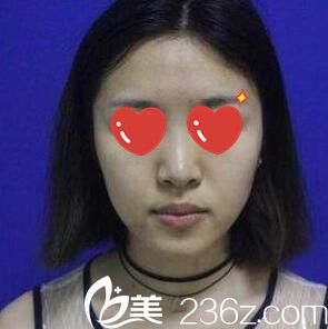 鼻整形術(shù)前照 鼻整形術(shù)前照