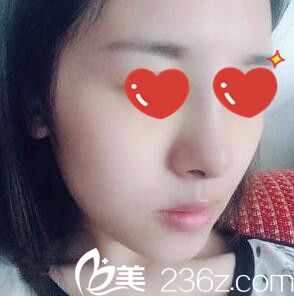 找崔尚默做鼻整形術(shù)后第八天 找崔尚默做鼻整形術(shù)后第八天