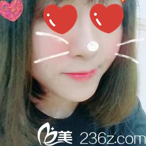 看我找韓國美Plus整形醫(yī)院崔尚默做的假體隆鼻2個月效果怎么樣