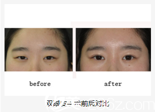美藝雙眼皮整形前后對(duì)比