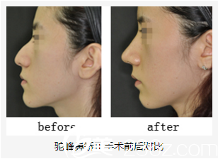 美藝鼻矯正前后對(duì)比