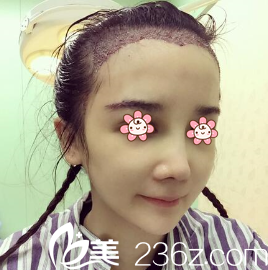 王昌林醫(yī)生剛做完毛發(fā)移植