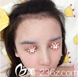 <!--<i data=20240703-sp></i>-->整形發(fā)際線調(diào)整術(shù)后一個月