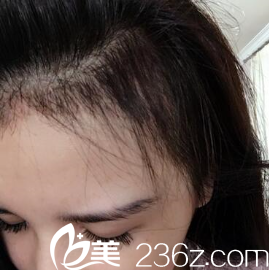 <!--<i data=20240703-sp></i>-->王昌林毛發(fā)移植術(shù)后兩個月