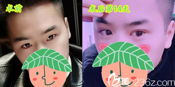 石良兵院長各割雙眼皮術(shù)前術(shù)后案例對比照片 石良兵院長各割雙眼皮術(shù)前術(shù)后案例對比照片