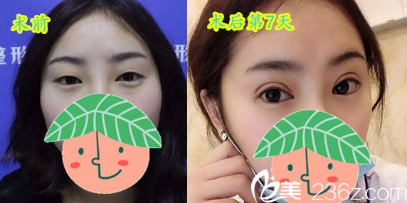 找石良兵主任做全切雙眼皮7天恢復(fù)效果 找石良兵主任做全切雙眼皮7天恢復(fù)效果