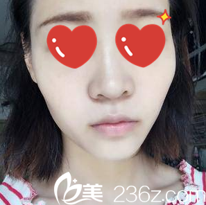 在美藝做鼻整形術(shù)前照 在美藝做鼻整形術(shù)前照