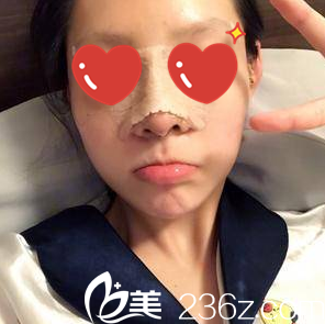 在美藝做假體隆鼻+脂肪填充面部第三天 在美藝做假體隆鼻+脂肪填充面部第三天