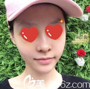 假體隆鼻+自體脂肪填充面部一周拆線 假體隆鼻+自體脂肪填充面部一周拆線