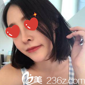 美藝自體脂肪填充+隆鼻一個(gè)月 美藝自體脂肪填充+隆鼻一個(gè)月