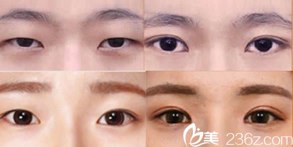 韓國然美之整形醫(yī)院李東勛院長雙眼皮案例圖 韓國然美之整形醫(yī)院李東勛院長雙眼皮案例圖