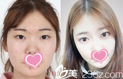 金度焰院長(zhǎng)面部輪廓+雙眼皮手術(shù)案例對(duì)比照 金度焰院長(zhǎng)面部輪廓+雙眼皮手術(shù)案例對(duì)比照