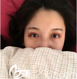 寧夏華美雙眼皮術(shù)后6天 寧夏華美雙眼皮術(shù)后6天