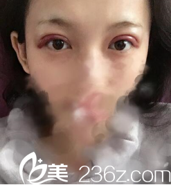 手術(shù)第二天 手術(shù)第二天