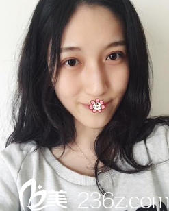 何林全切雙眼皮術(shù)后13天 何林全切雙眼皮術(shù)后13天