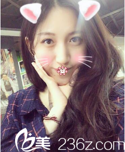 寧夏華美何林雙眼皮術(shù)后27天 寧夏華美何林雙眼皮術(shù)后27天