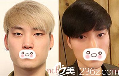 面部輪廓+雙眼皮手術對比效果