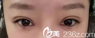 吳偉林醫(yī)生雙眼皮手術(shù)案例