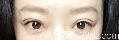 雙眼皮術(shù)后15天恢復(fù)效果