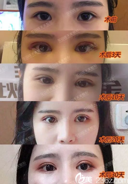 找連天美醫(yī)生做雙眼皮30天恢復(fù)過程圖 找連天美醫(yī)生做雙眼皮30天恢復(fù)過程圖