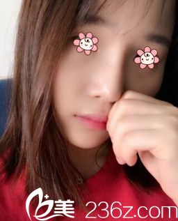 在董彭濤那兒做完膨體隆鼻+鼻綜合發(fā)現(xiàn)寧夏華美整形美容醫(yī)院口碑怎么樣不是迷了。