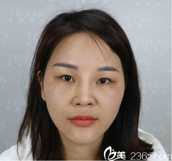 眼綜合手術(shù)前