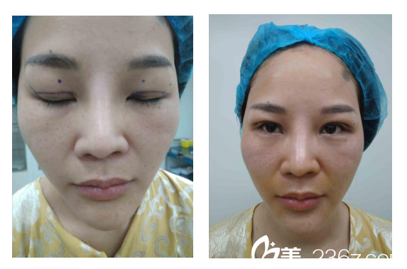 寧波童顏眼綜合手術(shù)